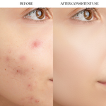 Hydrocolloid Acne Patch