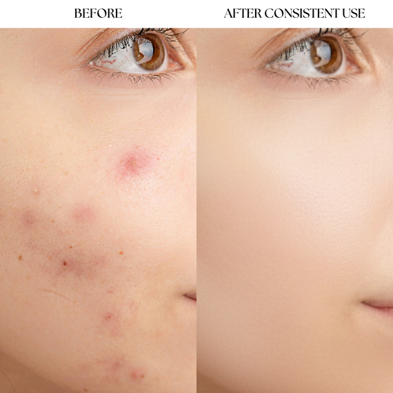Hydrocolloid Acne Patch image-11